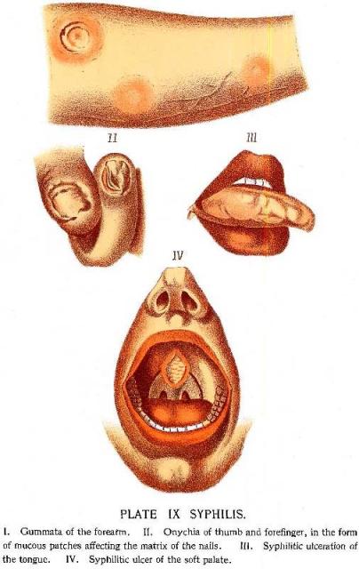 Plate 9. Syphilis.