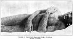 Figure 8: Confluent smallpox.