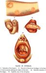 Plate 9. Syphilis.